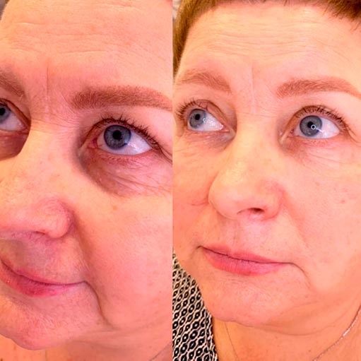 Preston Skin Medicine and Beauty Clinic, TwAc Eyes Mesotherapy Skin Boosters Injectables, Product for delicate eye area wrinkles