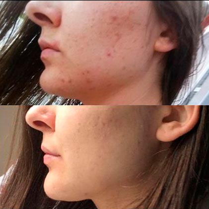 Preston Skin Medicine Aesthetician, Beauty Clinic Lancashire, Microneedling Dermapen Treatments
